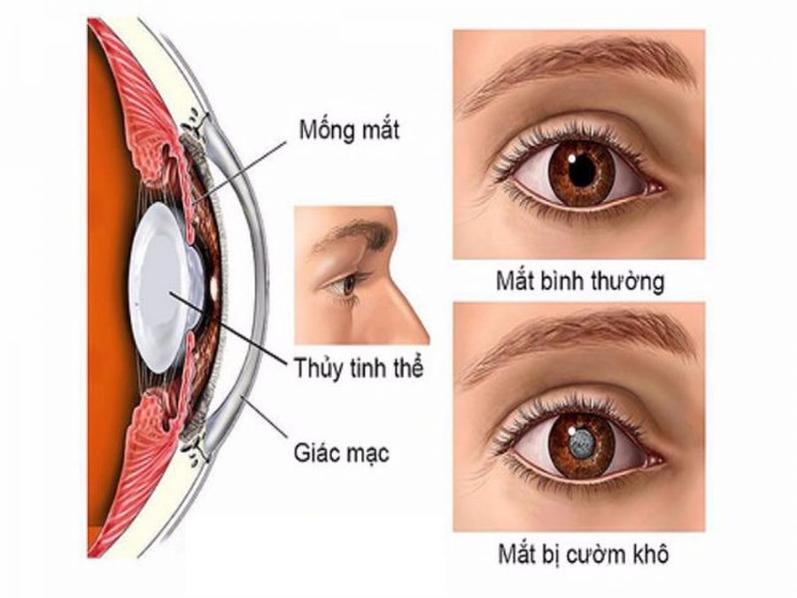 Hạt Cườm Trong Mắt Gallery 2