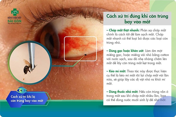 Côn trùng bay vào mắt gây đau rất nhiều: Cách xử lý và phòng ngừa Gallery 1