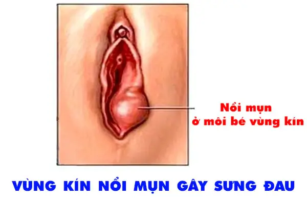 Mọc Mụn Ở Âm Đạo Gallery 2