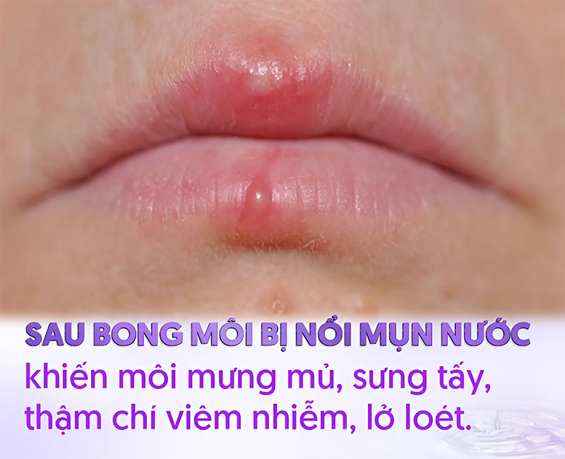 Xăm môi bị bọng nước phải làm sao? Gallery 2