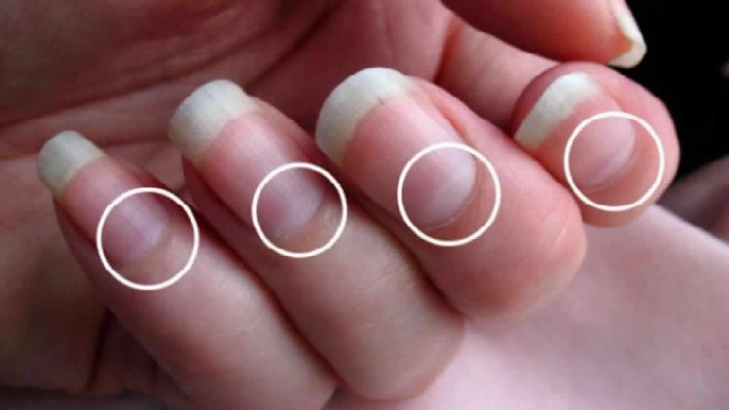Móng Tay Không Có Vầng Trăng: Nguyên Nhân và Điều Trị Gallery 2