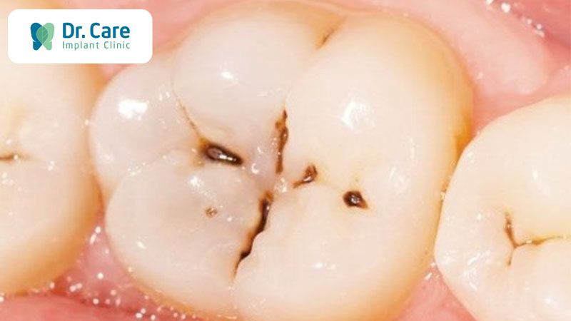 Răng có chấm đen phải làm sao? Gallery 2
