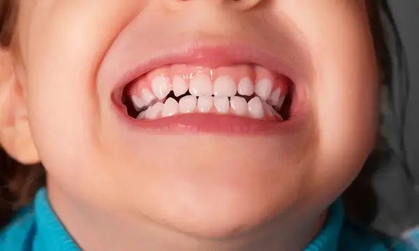 Trẻ dưới 1 tuổi hay nghiến răng: Nguyên nhân và cách xử lý Gallery 2