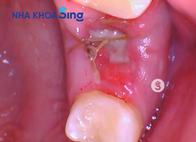 Xuất hiện màng trắng sau khi nhổ răng: Nguyên nhân và cách xử lý Gallery 2