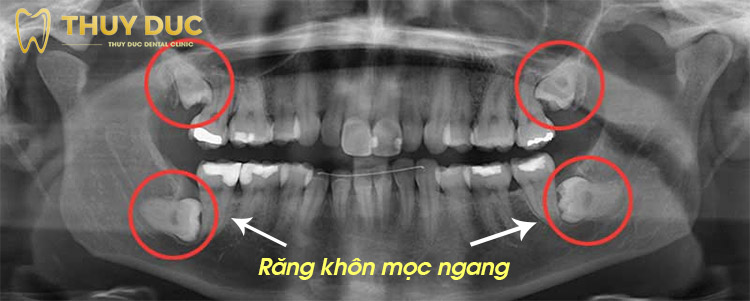 Răng Khôn Nằm Ngang Gallery 2