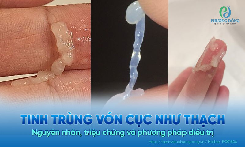 Tinh trùng như thạch: Nguyên nhân và cách xử lý Gallery 2