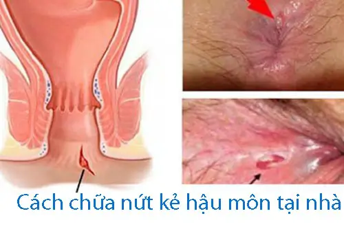 Nứt Kẽ Hậu Môn Phải Làm Sao? Gallery 1