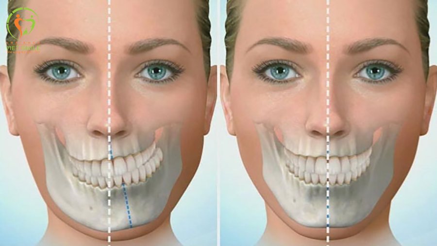 Bị Méo Miệng Phải Làm Sao? Gallery 2