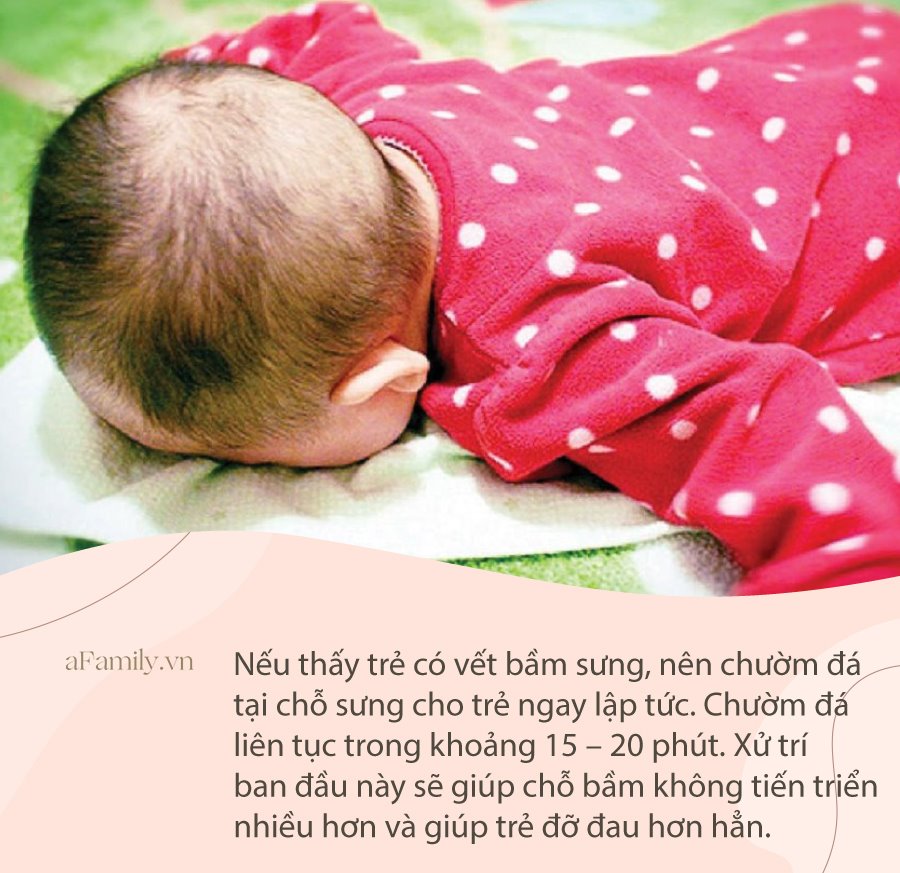 Trẻ Ngã Sưng Đầu: Cách Xử Trí Và Khi Nào Cần Đến Bệnh Viện Gallery 1