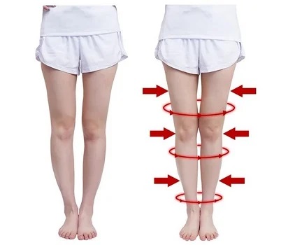 Cải thiện chân vòng kiềng