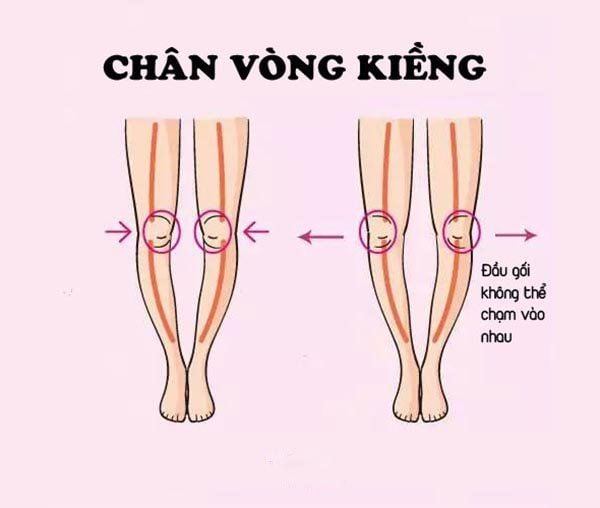 Cải thiện chân vòng kiềng Gallery 2