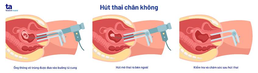 Nạo phá thai có đau không? Gallery 1