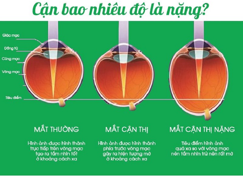 Cận Bao Nhiêu Độ Là Mù?