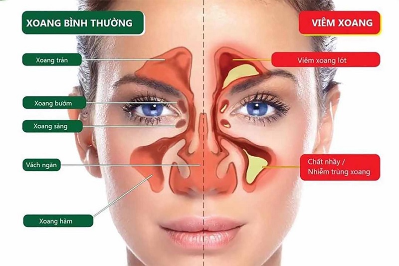 Cánh Mũi Có Mùi Hôi: Nguyên Nhân và Cách Khắc Phục