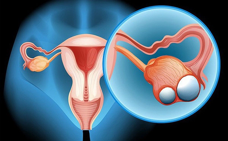 Cắt 1 Bên Buồng Trứng