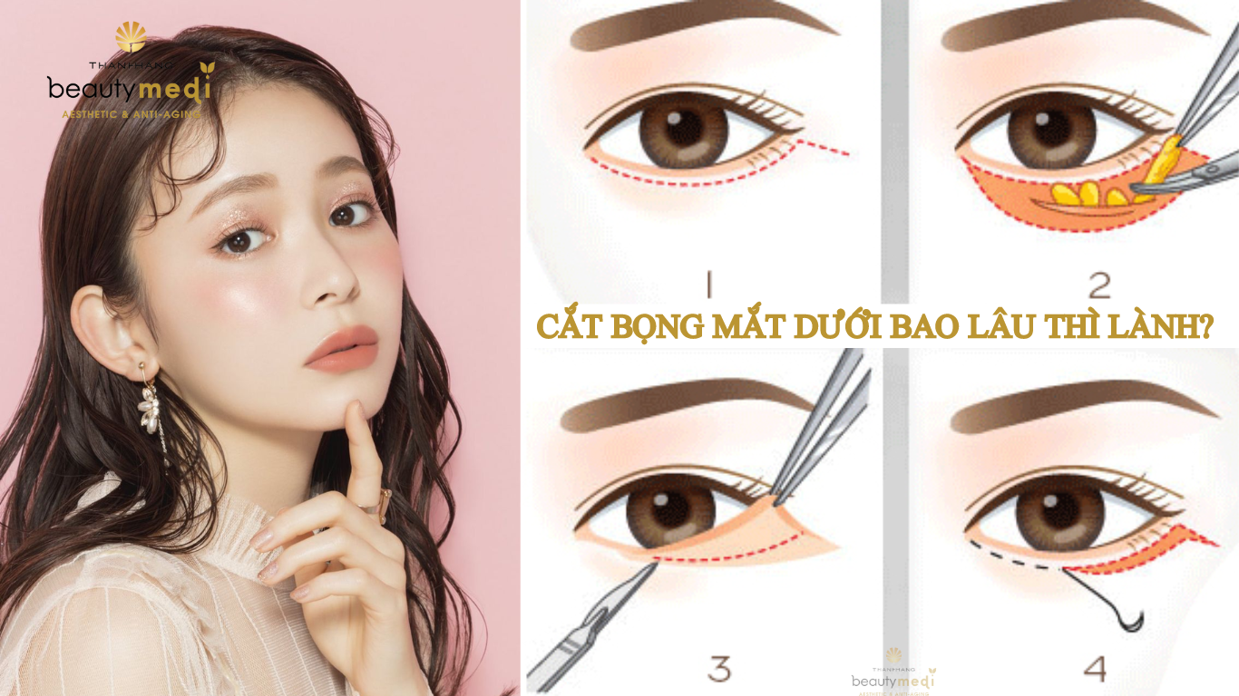 Cắt Bọng Mắt Dưới: Giúp Bạn Trẻ Hơn, Tự Tin Hơn