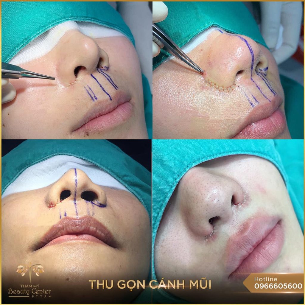 Cắt cánh mũi bao lâu thì lành?