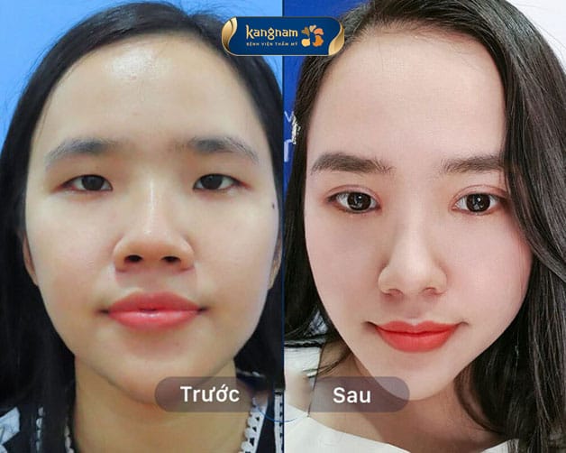 Cắt cánh mũi bao lâu thì lành? Gallery 2