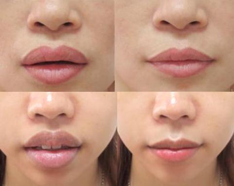 Cắt Khoé Miệng Cười: Nụ Cười Tươi Tắn, Rạng Rỡ