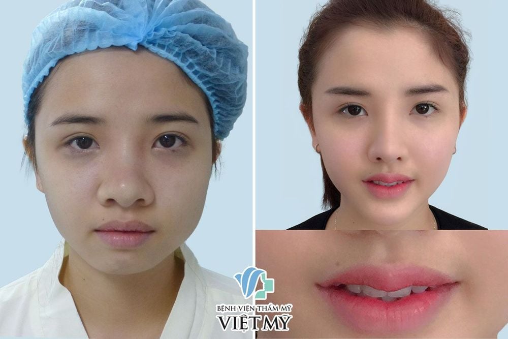 Cắt môi dày thành mỏng