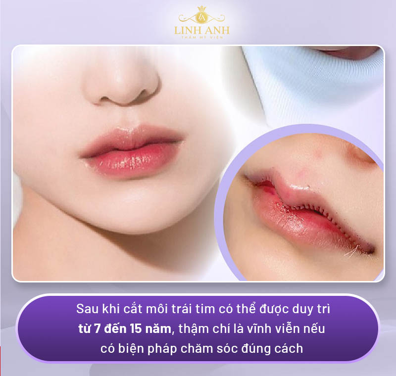 Cắt môi trái tim có được vĩnh viễn không?