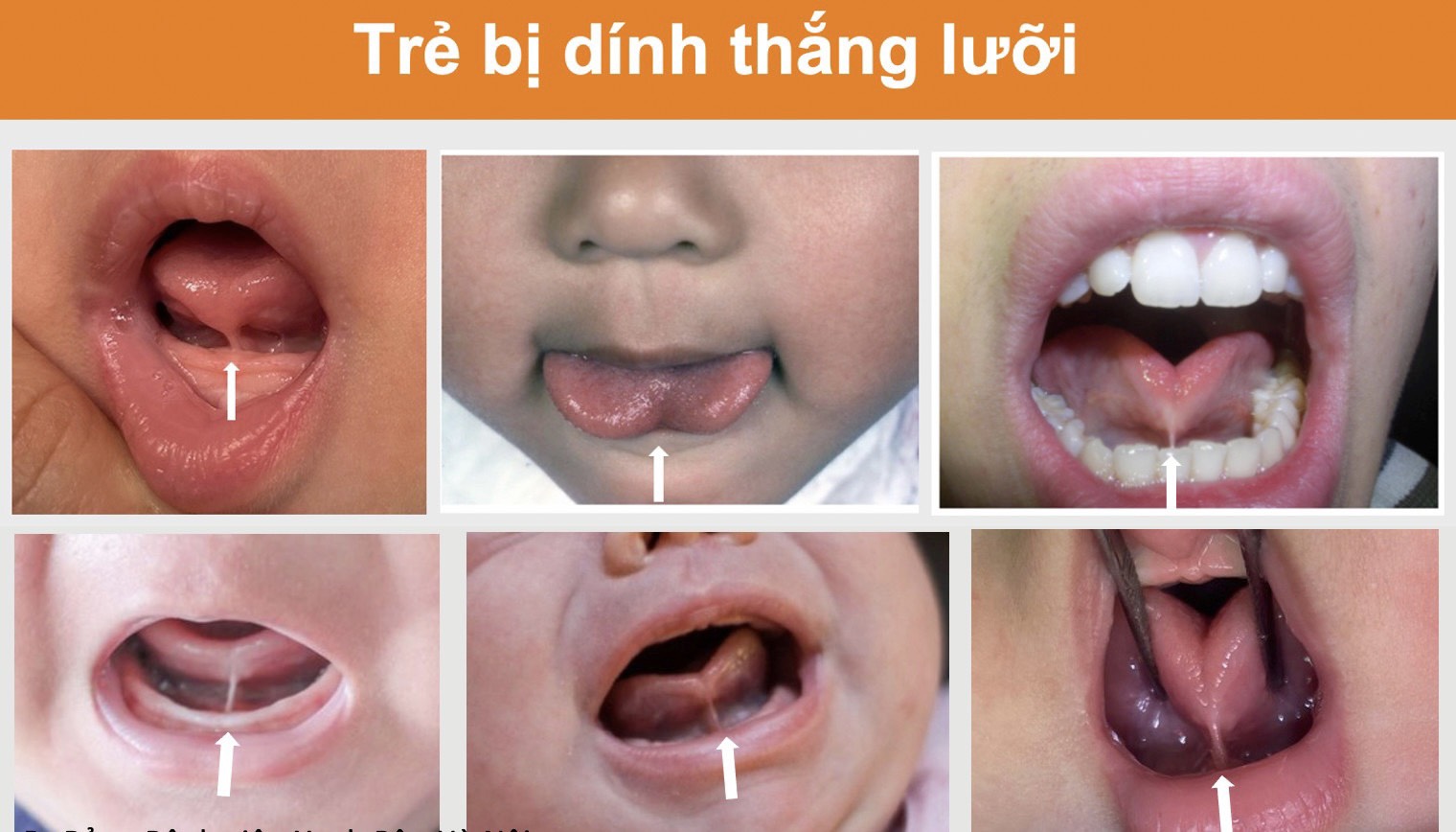 Cắt thắng lưỡi bao lâu lành?