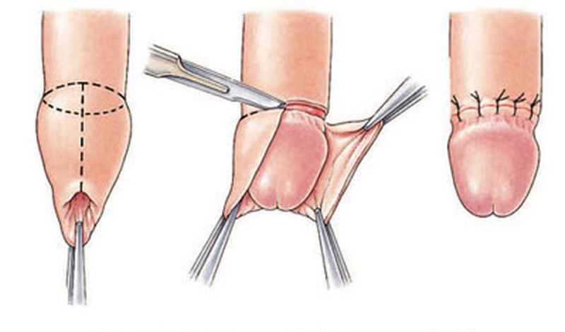 Cậu nhỏ đau rát sau khi quan hệ: Nguyên nhân và cách khắc phục
