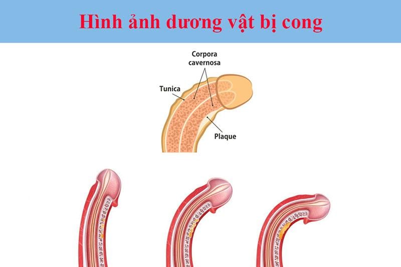 Cậu nhỏ bị nghiêng sang trái: Nguyên nhân và cách xử trí