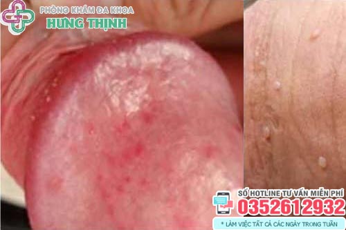 Cậu nhỏ bị ngứa: Nguyên nhân và cách điều trị