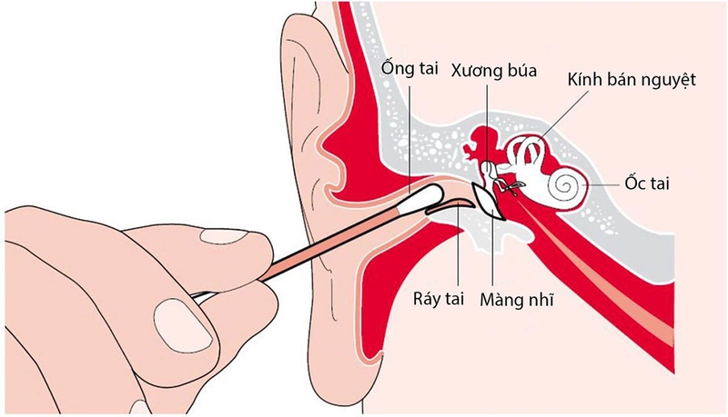 Ráy tai từ đâu mà có? Gallery 1