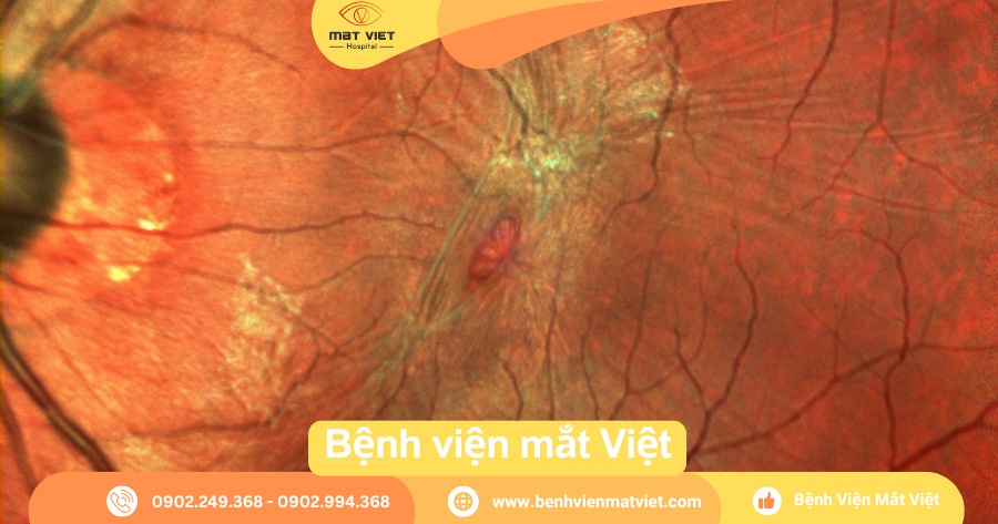 Màng Trước Võng Mạc Gallery 1