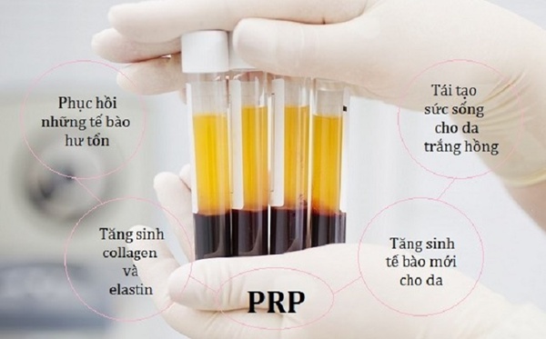 Cấy máu tự thân có tốt không?