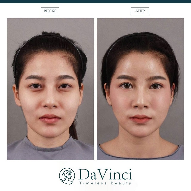 Cấy mỡ thái dương bao nhiêu tiền?