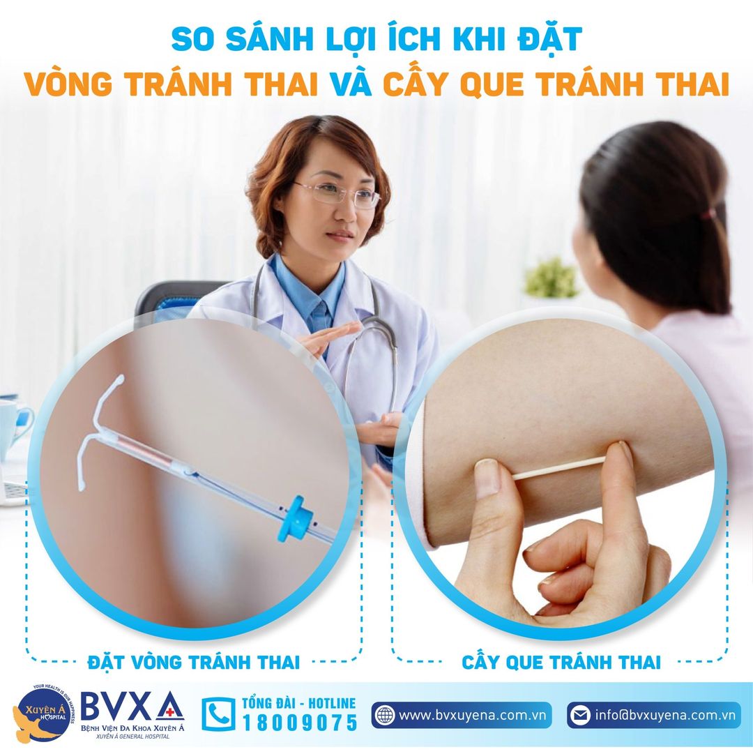 Cấy que hay đặt vòng tốt hơn?