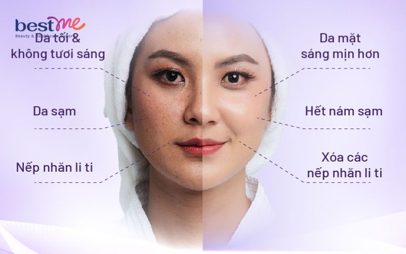Cấy trắng da mặt được bao lâu?