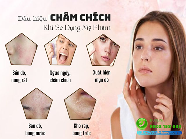 Châm chích là gì?