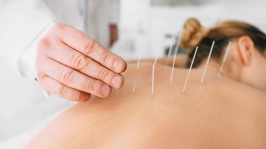 Châm cứu tiếng Anh là gì