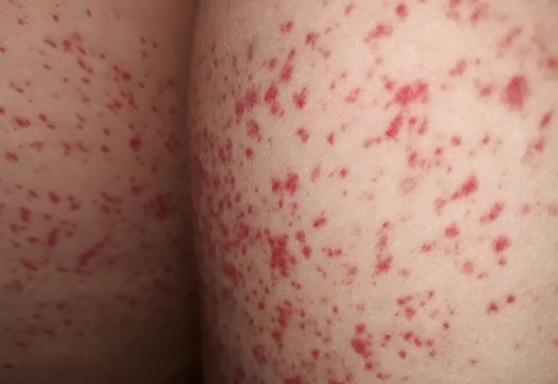 Chấm đỏ li ti trên da: Nguyên nhân và cách điều trị