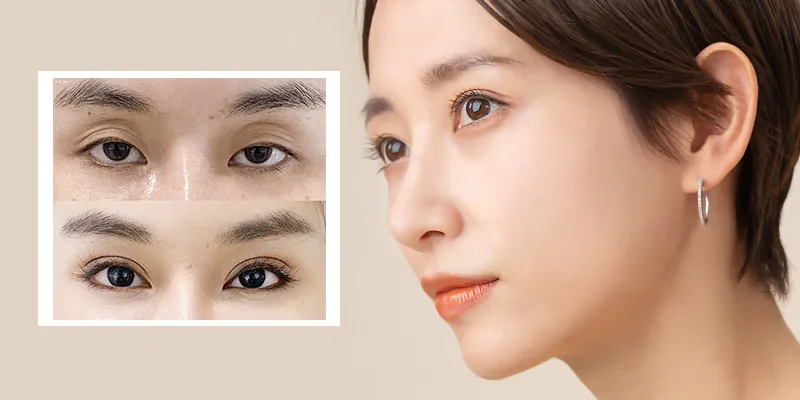 Cách Làm Đầy Hốc Mắt Tự Nhiên Gallery 2