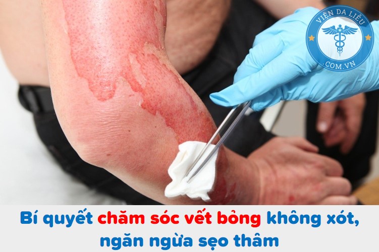 Trị Sẹo Bỏng Nước Sôi Lâu Năm Gallery 2
