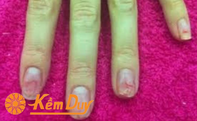 Cách để móng tay dài nhanh và cứng Gallery 2