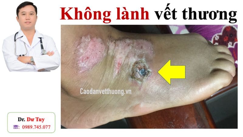 Cách Mau Lành Vết Thương Té Xe Gallery 2