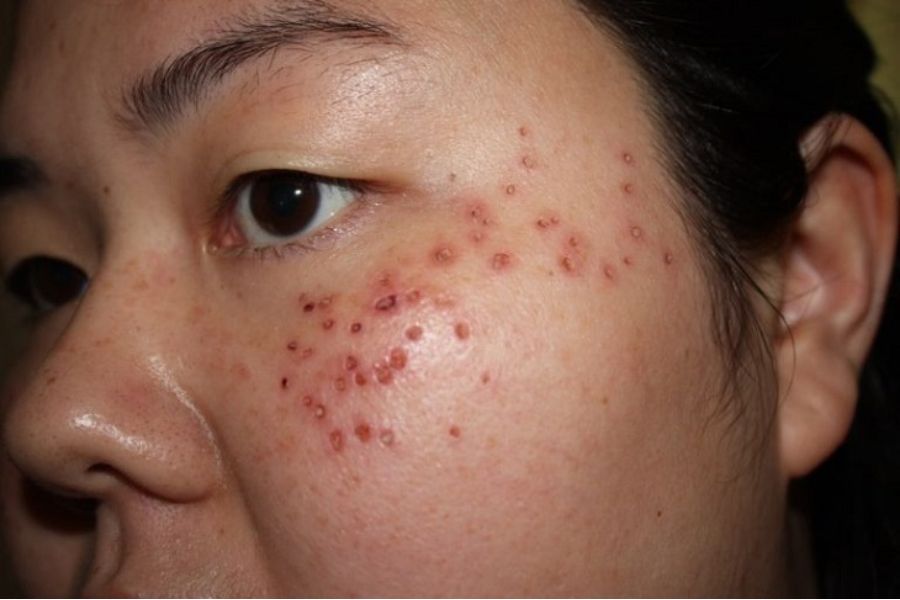 Chấm tàn nhang có để lại sẹo không?