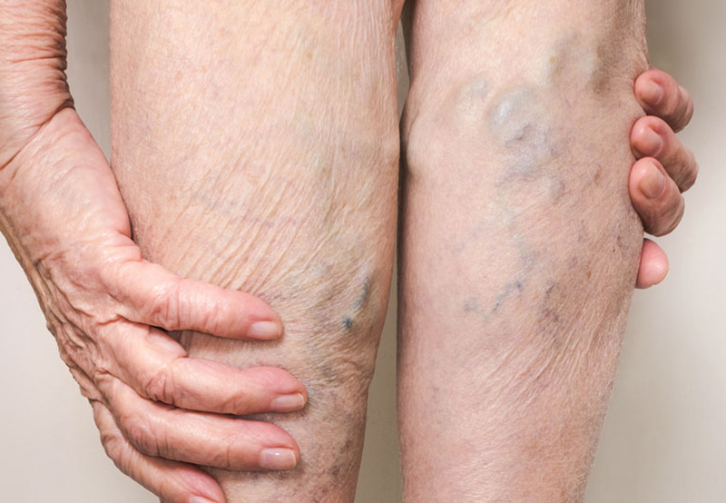 Chân bị nổi gân xanh: Nguyên nhân, triệu chứng và cách điều trị