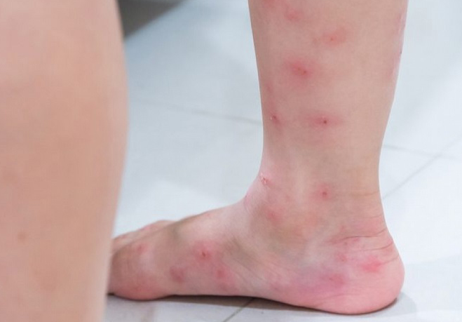 Chân bị nổi mẩn đỏ và ngứa vào mùa đông: Nguyên nhân và cách khắc phục