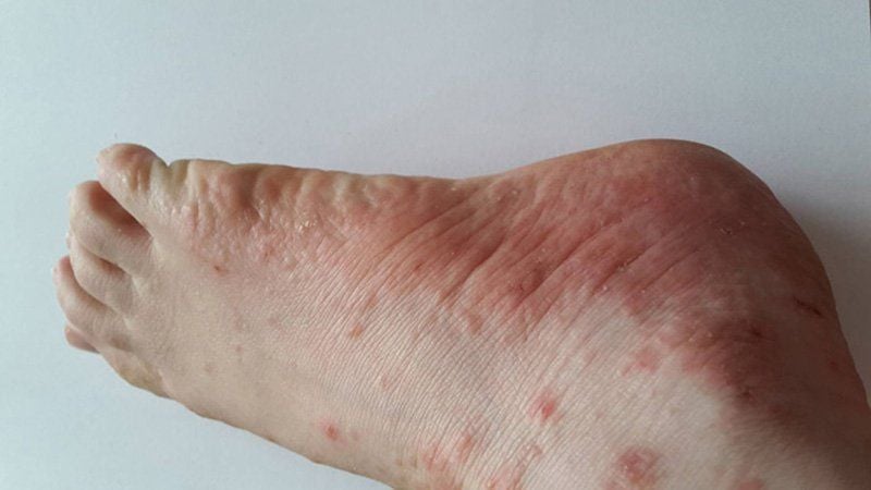 Chân bị tổ đỉa: Nguyên nhân, triệu chứng và cách điều trị