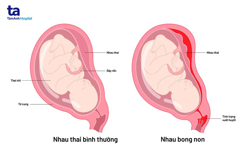 Thai 5 tuần có hiện tượng bong rau Gallery 2