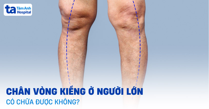 Chân Kiềng Là Gì?
