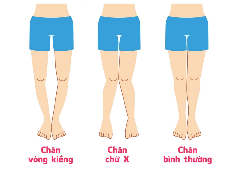 Chân Kiềng Là Gì? Gallery 2