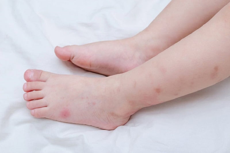 Chân nổi đốm đỏ ngứa: Nguyên nhân và cách điều trị
